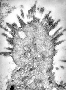 M,18y. | immotile cilia syndrome - bronchus - microvillous prominence